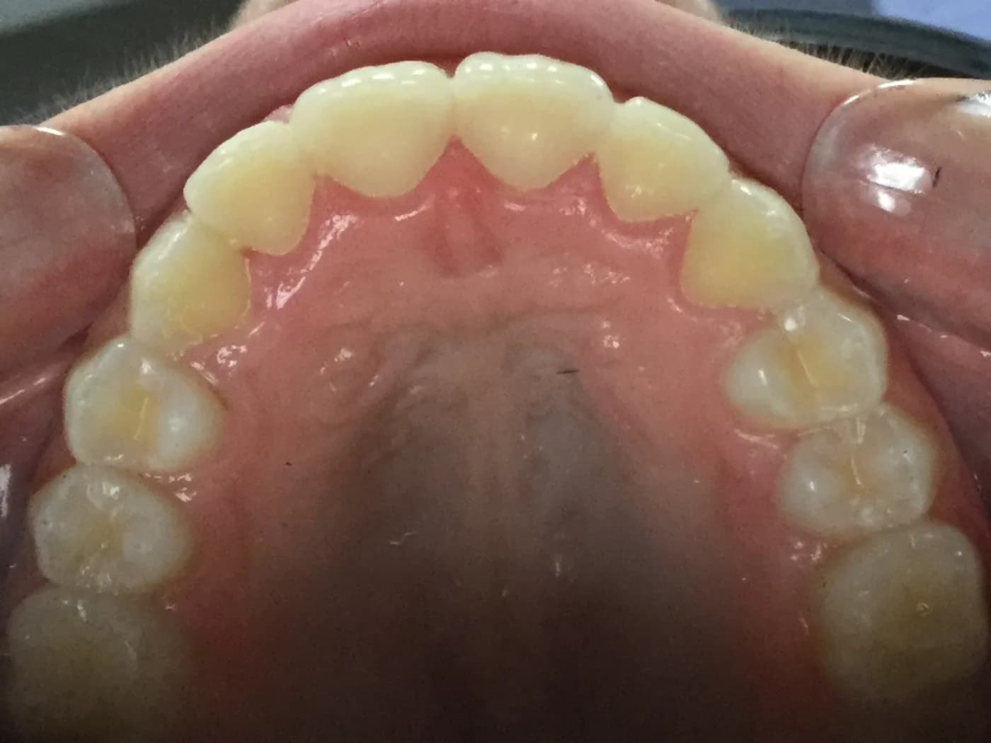 After treatment, broadened dental arch