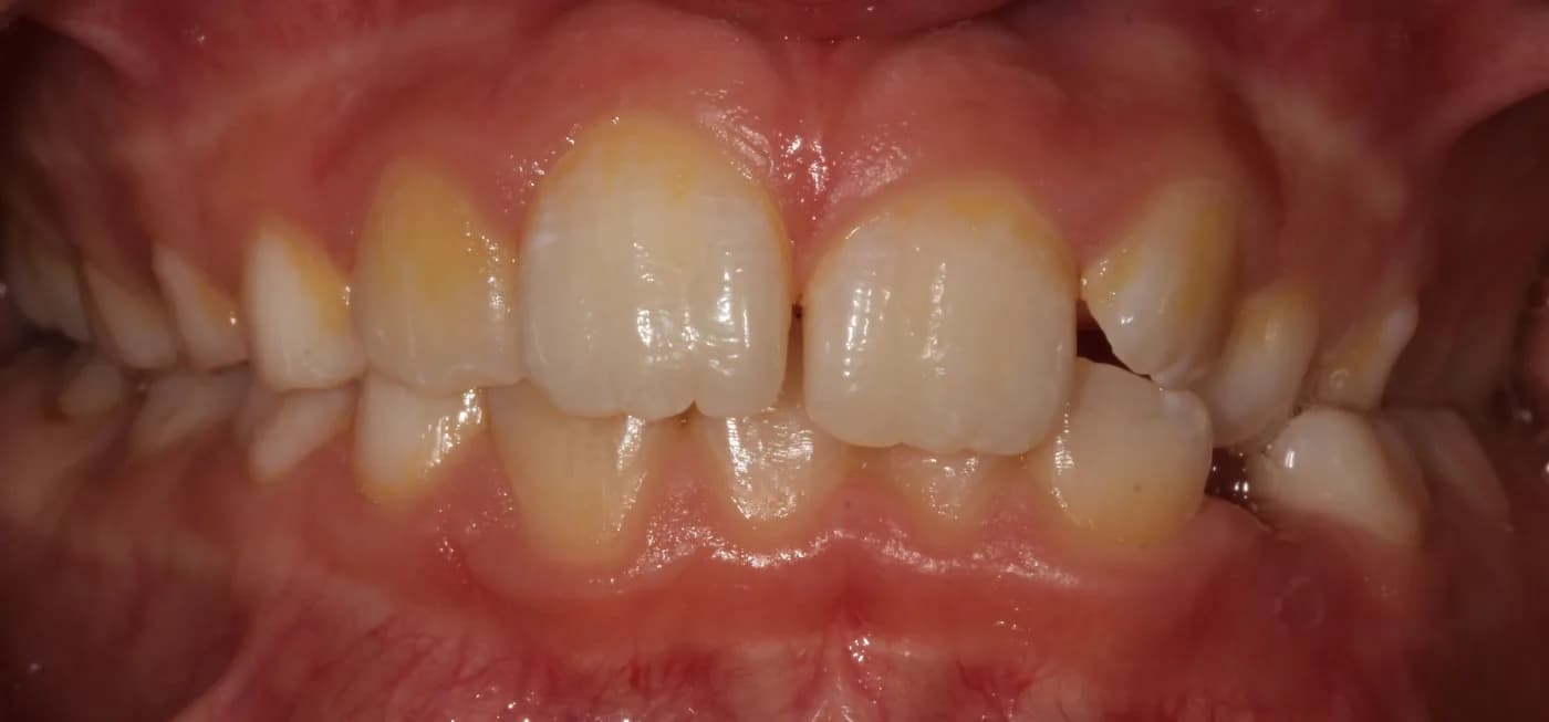 Before treatment, front view of bite
