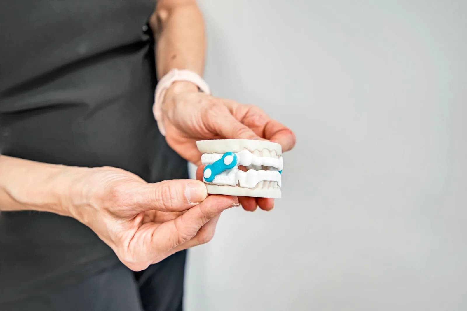 An oral sleep appliance shown on a dental model of the upper and lower arches