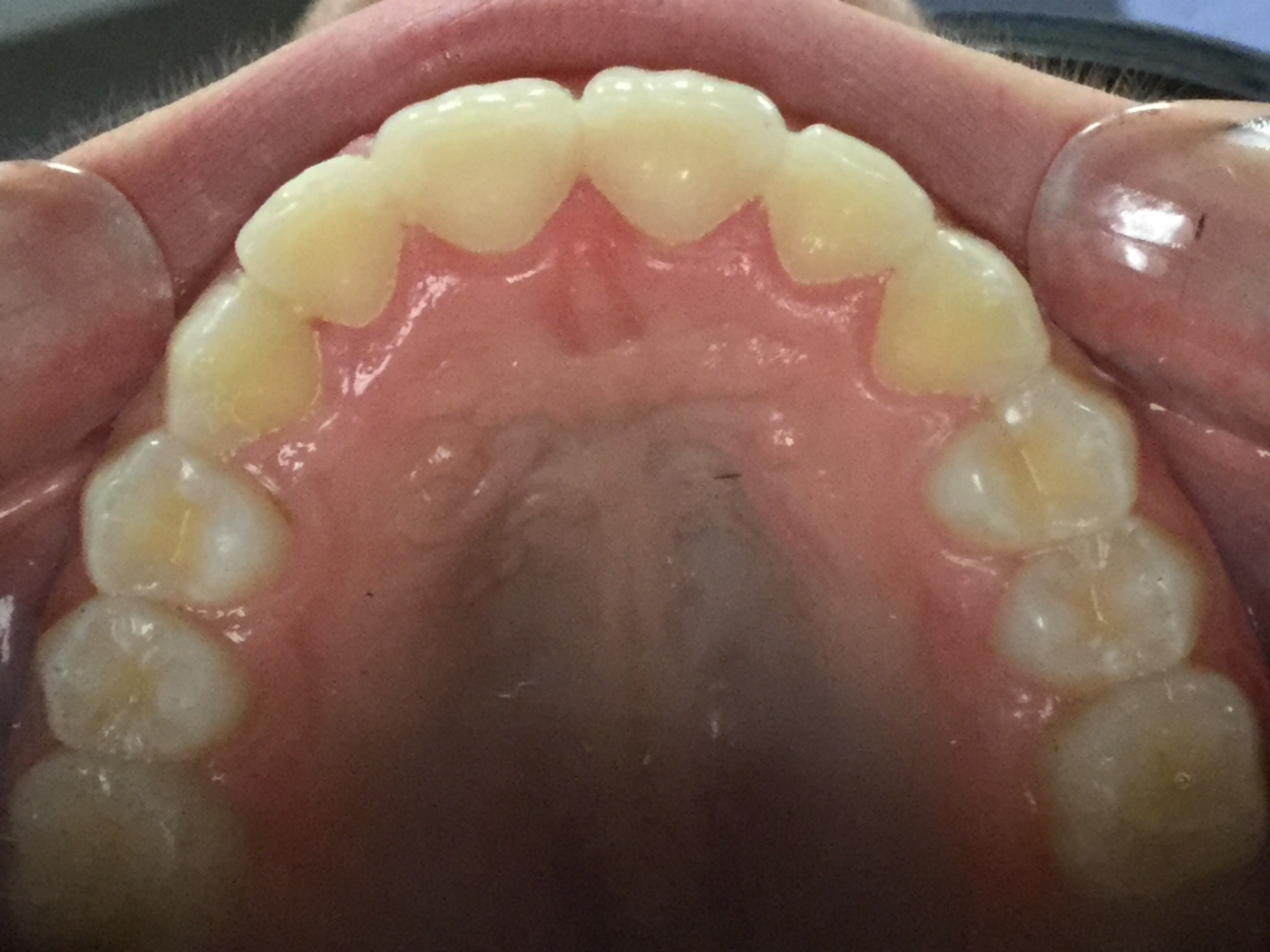 After treatment, broadened dental arch