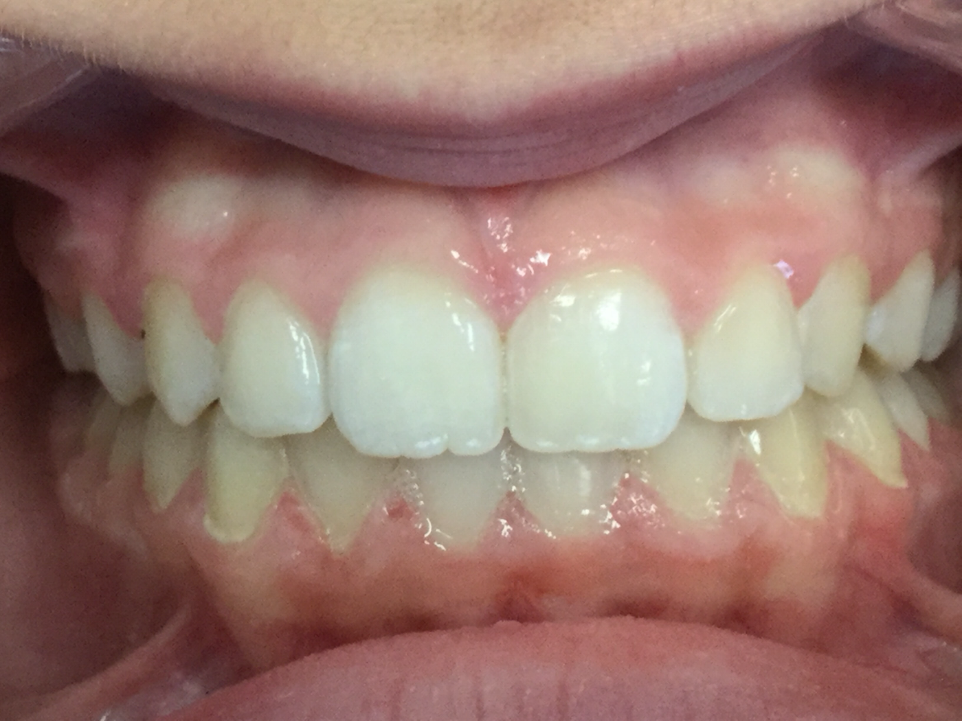 After treatment, front view of bite