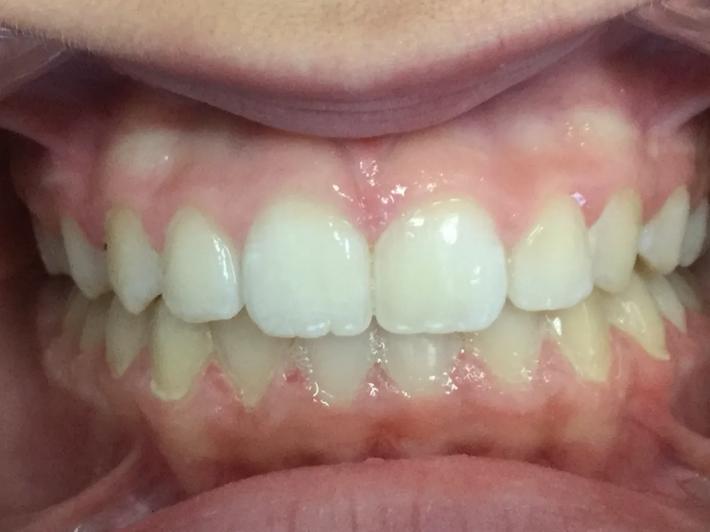 After treatment, front view of bite