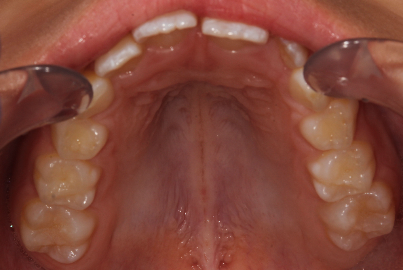 Before treatment, narrow dental arch