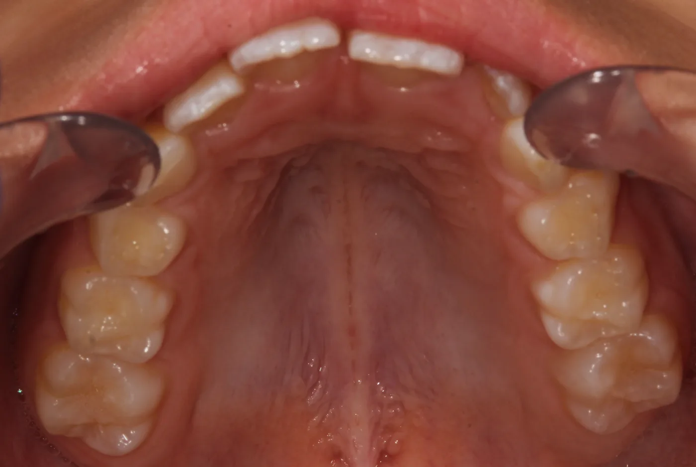 Before treatment, narrow dental arch