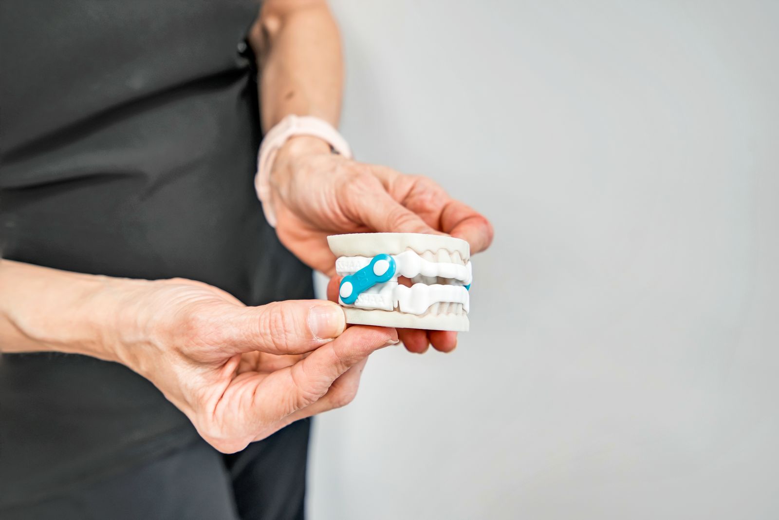 An oral sleep appliance shown on a dental model of the upper and lower arches