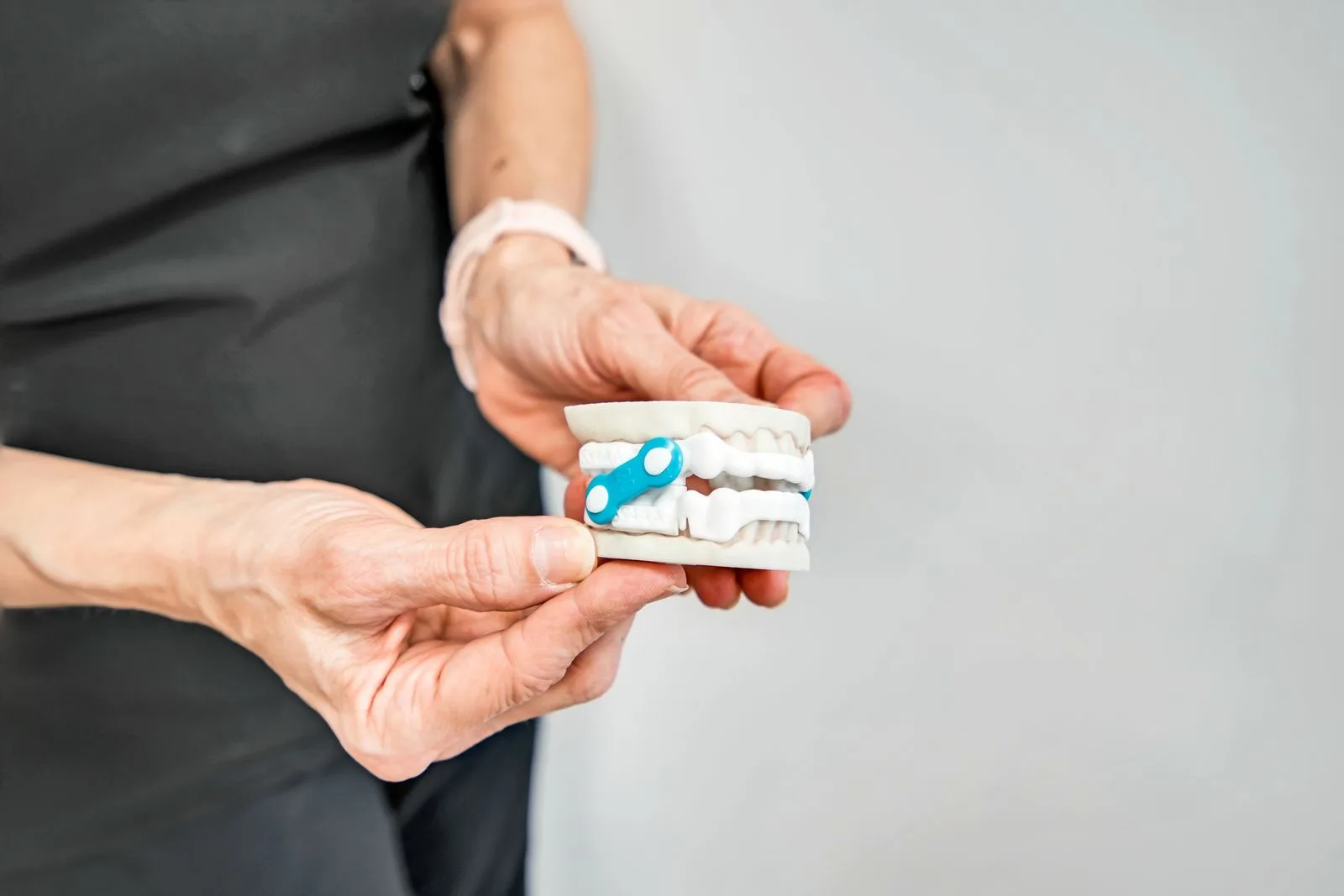 An oral sleep appliance shown on a dental model of the upper and lower arches
